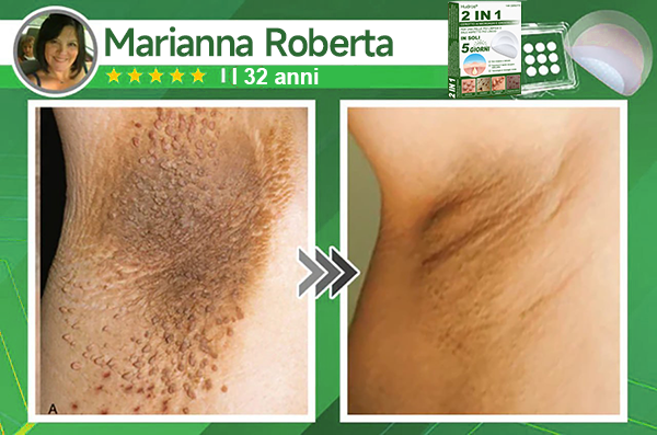 👉Hudros®🐒Cerotto 2 in 1 a Micro-aghi e Idrocolloide | Elimina Nevi in Rilievo, Acne, Verruche Piatte e Fibromi Cutanei | Migliora Rughe, Cicatrici e Imperfezioni | Cerotti Stella Invisibili per Brufoli su Viso e Corpo | 144 pz.🐑