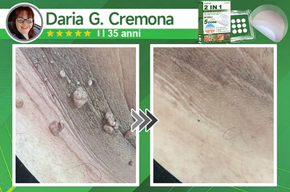 👉Hudros®🐒Cerotto 2 in 1 a Micro-aghi e Idrocolloide | Elimina Nevi in Rilievo, Acne, Verruche Piatte e Fibromi Cutanei | Migliora Rughe, Cicatrici e Imperfezioni | Cerotti Stella Invisibili per Brufoli su Viso e Corpo | 144 pz.🐑