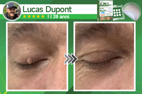 👉Hudros®🐒Cerotto 2 in 1 a Micro-aghi e Idrocolloide | Elimina Nevi in Rilievo, Acne, Verruche Piatte e Fibromi Cutanei | Migliora Rughe, Cicatrici e Imperfezioni | Cerotti Stella Invisibili per Brufoli su Viso e Corpo | 144 pz.🐑