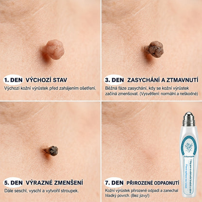 𝑻𝒓𝒊𝒍𝒖𝒎𝒊𝒂®💎🍃 Prémiový roller | 🔬 Na odstranění bradavic, znamének a výrůstků 🇨🇿