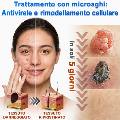 👉Hudros®🐒Cerotto 2 in 1 a Micro-aghi e Idrocolloide | Elimina Nevi in Rilievo, Acne, Verruche Piatte e Fibromi Cutanei | Migliora Rughe, Cicatrici e Imperfezioni | Cerotti Stella Invisibili per Brufoli su Viso e Corpo | 144 pz.🐑