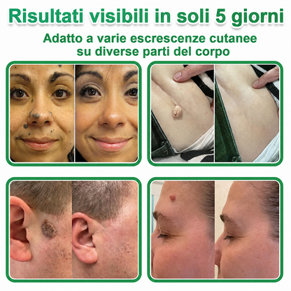👉Hudros®🐒Cerotto 2 in 1 a Micro-aghi e Idrocolloide | Elimina Nevi in Rilievo, Acne, Verruche Piatte e Fibromi Cutanei | Migliora Rughe, Cicatrici e Imperfezioni | Cerotti Stella Invisibili per Brufoli su Viso e Corpo | 144 pz.🐑