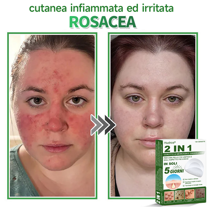 👉Hudros®🐒Cerotto 2 in 1 a Micro-aghi e Idrocolloide | Elimina Nevi in Rilievo, Acne, Verruche Piatte e Fibromi Cutanei | Migliora Rughe, Cicatrici e Imperfezioni | Cerotti Stella Invisibili per Brufoli su Viso e Corpo | 144 pz.🐑