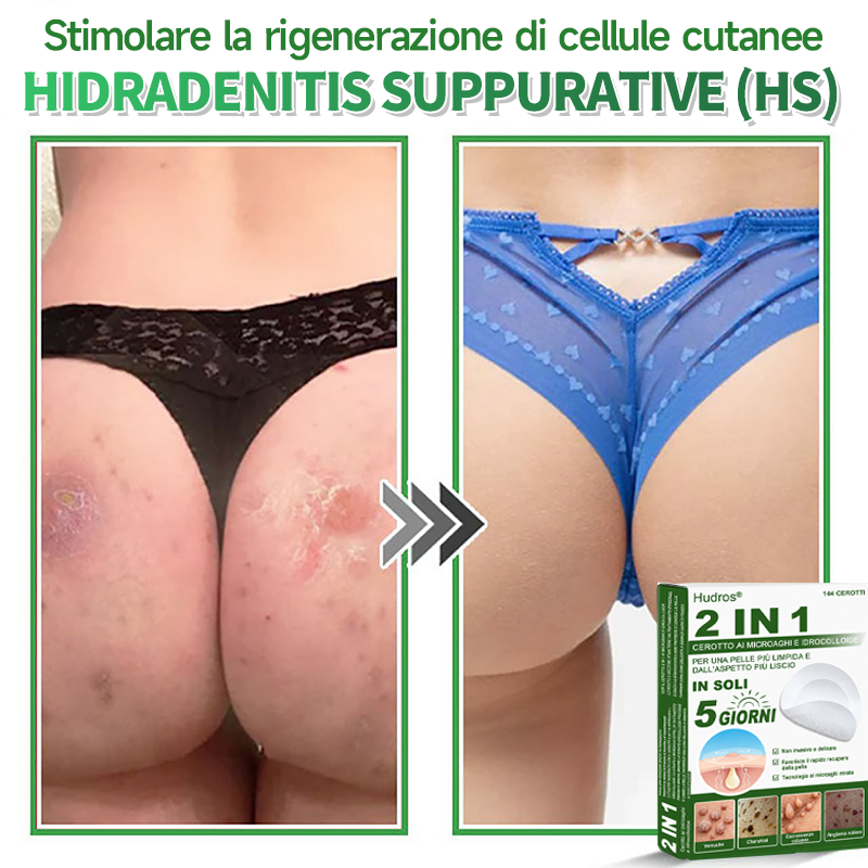 👉Hudros®🐒Cerotto 2 in 1 a Micro-aghi e Idrocolloide | Elimina Nevi in Rilievo, Acne, Verruche Piatte e Fibromi Cutanei | Migliora Rughe, Cicatrici e Imperfezioni | Cerotti Stella Invisibili per Brufoli su Viso e Corpo | 144 pz.🐑