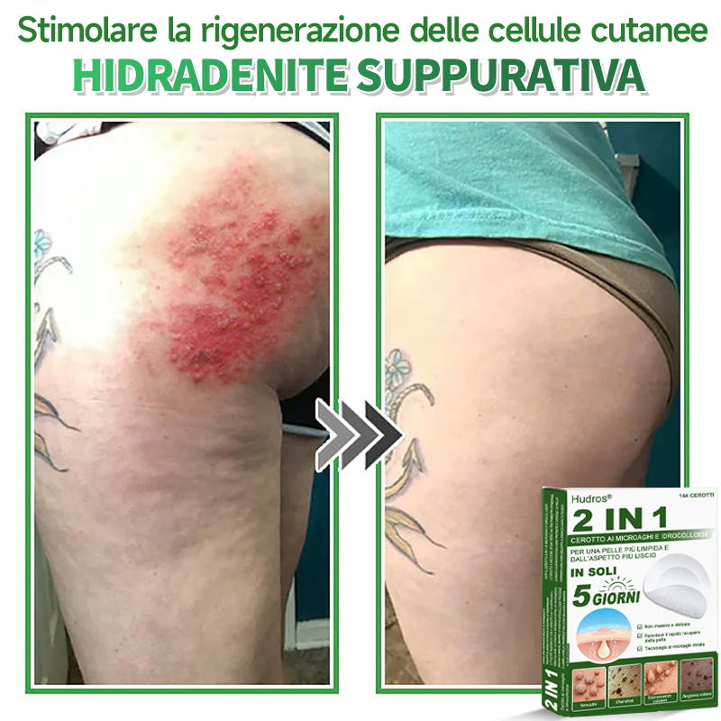 👉Hudros®🐒Cerotto 2 in 1 a Micro-aghi e Idrocolloide | Elimina Nevi in Rilievo, Acne, Verruche Piatte e Fibromi Cutanei | Migliora Rughe, Cicatrici e Imperfezioni | Cerotti Stella Invisibili per Brufoli su Viso e Corpo | 144 pz.🐑
