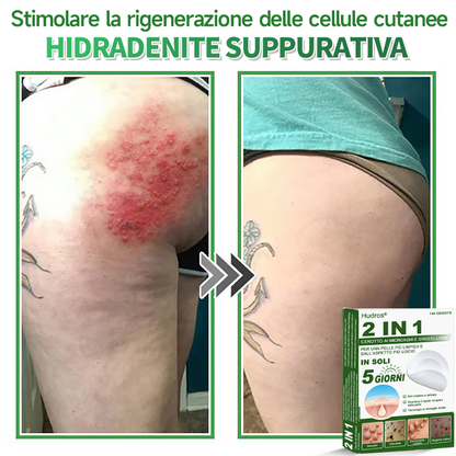 👉Hudros®🐒Cerotto 2 in 1 a Micro-aghi e Idrocolloide | Elimina Nevi in Rilievo, Acne, Verruche Piatte e Fibromi Cutanei | Migliora Rughe, Cicatrici e Imperfezioni | Cerotti Stella Invisibili per Brufoli su Viso e Corpo | 144 pz.🐑