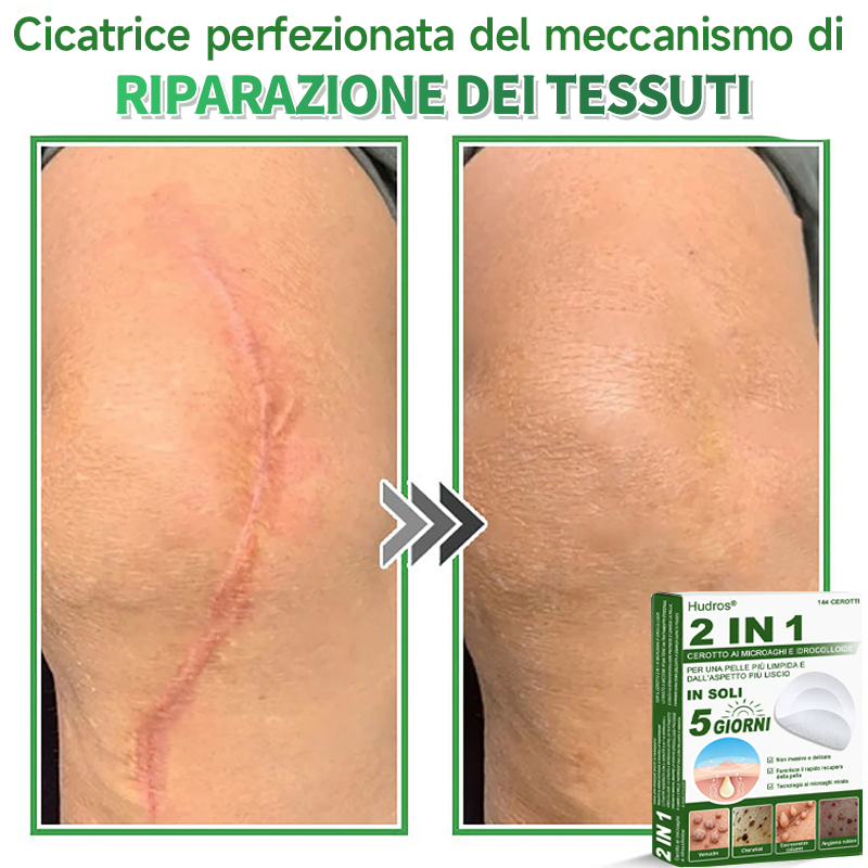 👉Hudros®🐒Cerotto 2 in 1 a Micro-aghi e Idrocolloide | Elimina Nevi in Rilievo, Acne, Verruche Piatte e Fibromi Cutanei | Migliora Rughe, Cicatrici e Imperfezioni | Cerotti Stella Invisibili per Brufoli su Viso e Corpo | 144 pz.🐑