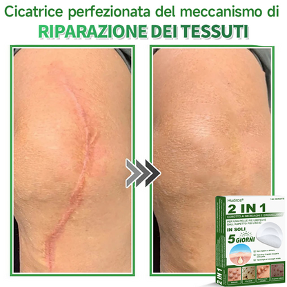 👉Hudros®🐒Cerotto 2 in 1 a Micro-aghi e Idrocolloide | Elimina Nevi in Rilievo, Acne, Verruche Piatte e Fibromi Cutanei | Migliora Rughe, Cicatrici e Imperfezioni | Cerotti Stella Invisibili per Brufoli su Viso e Corpo | 144 pz.🐑