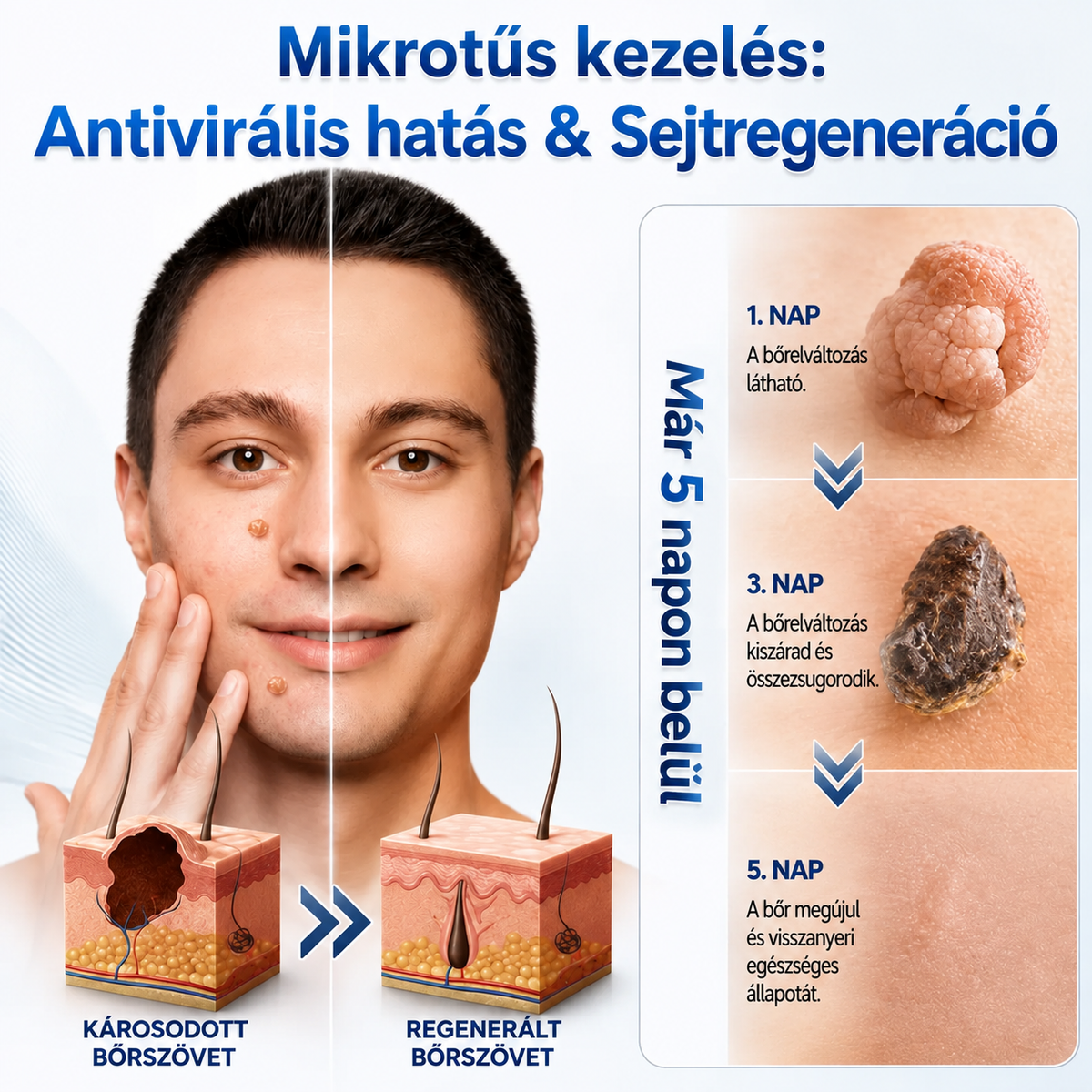 ✨ 𝑯𝒖𝒅𝒓𝒐𝒔® 💗 2-az-1-ben Mikrotű & Hidrokoloid Tapasz 🔬| Kiemelkedő Anyajegyek, Pattanások, Lapos Szemölcsök & Bőrkinövések Eltávolítója🛡️🦠 | Ráncok, Hegek & Bőrhibák Javítása | Láthatatlan Csillag Pattanástapasz Arcra & Testre | 144 db 🇭🇺