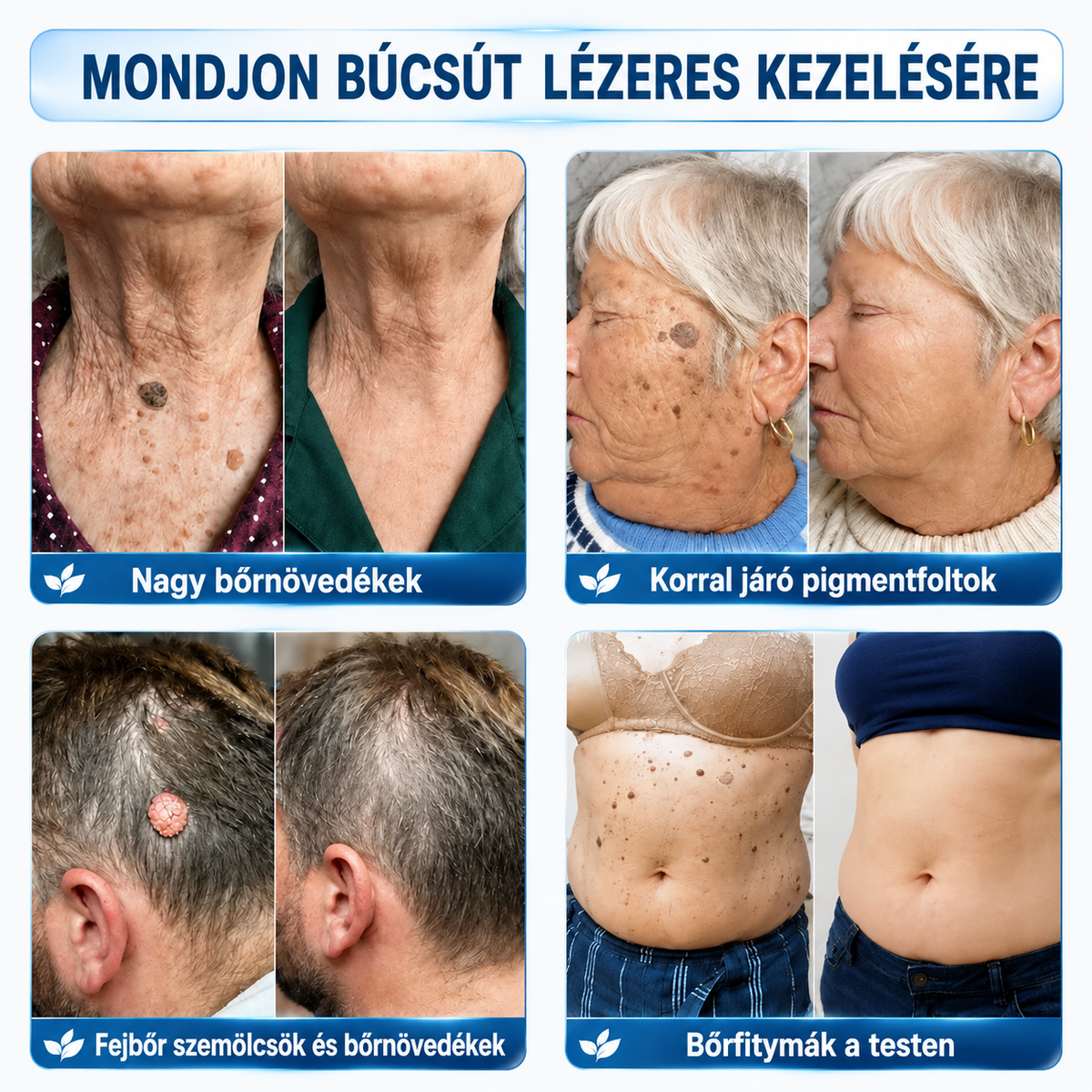 ✨ 𝑯𝒖𝒅𝒓𝒐𝒔® 💗 2-az-1-ben Mikrotű & Hidrokoloid Tapasz 🔬| Kiemelkedő Anyajegyek, Pattanások, Lapos Szemölcsök & Bőrkinövések Eltávolítója🛡️🦠 | Ráncok, Hegek & Bőrhibák Javítása | Láthatatlan Csillag Pattanástapasz Arcra & Testre | 144 db 🇭🇺