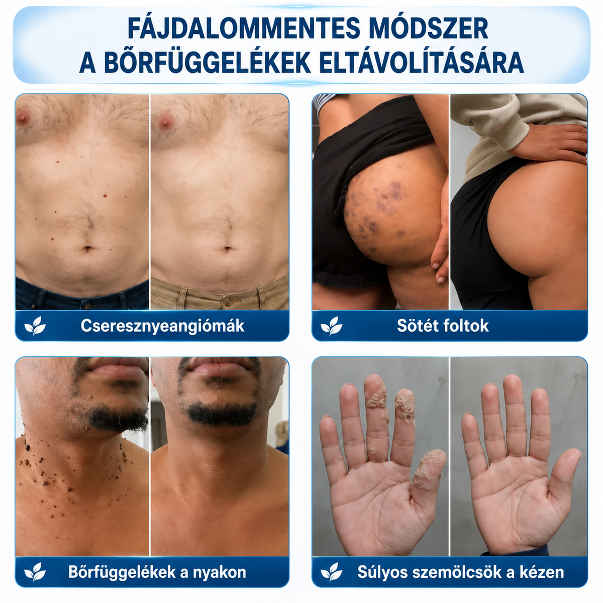 ✨ 𝑯𝒖𝒅𝒓𝒐𝒔® 💗 2-az-1-ben Mikrotű & Hidrokoloid Tapasz 🔬| Kiemelkedő Anyajegyek, Pattanások, Lapos Szemölcsök & Bőrkinövések Eltávolítója🛡️🦠 | Ráncok, Hegek & Bőrhibák Javítása | Láthatatlan Csillag Pattanástapasz Arcra & Testre | 144 db 🇭🇺